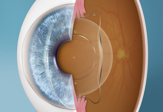 Peninsula Laser Eye Medical Group Visian ICL