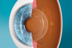 EVO ICL Lens Implant