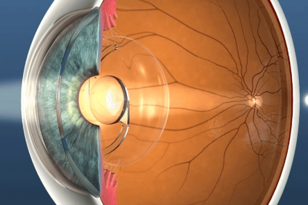 Refractive Lens Exchange